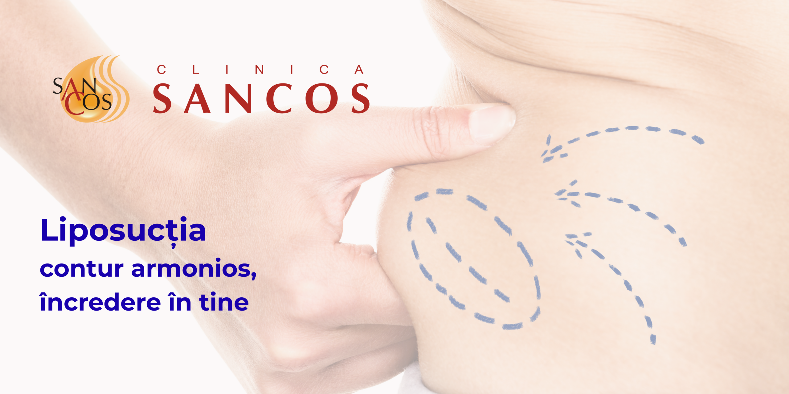 SANCOS – Liposucția – redefinește armonios conturul corpului și recâștigă încrederea în tine